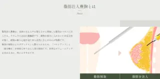 Re:Birth Clinic　施術メニュー画像　脂肪注入豊胸