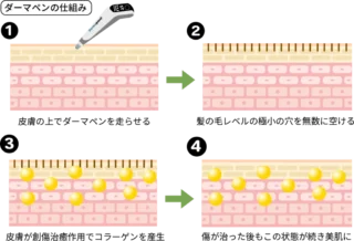 L’amour clinic Tokyo ダーマペン