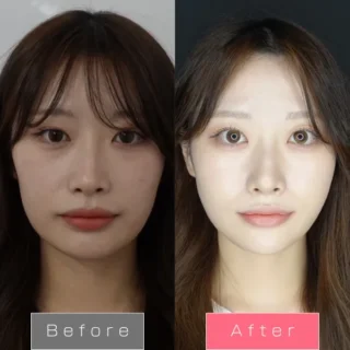 糸リフト（WPCL）８本