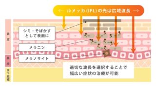 lamour-clinic-tokyoルメッカ説明図