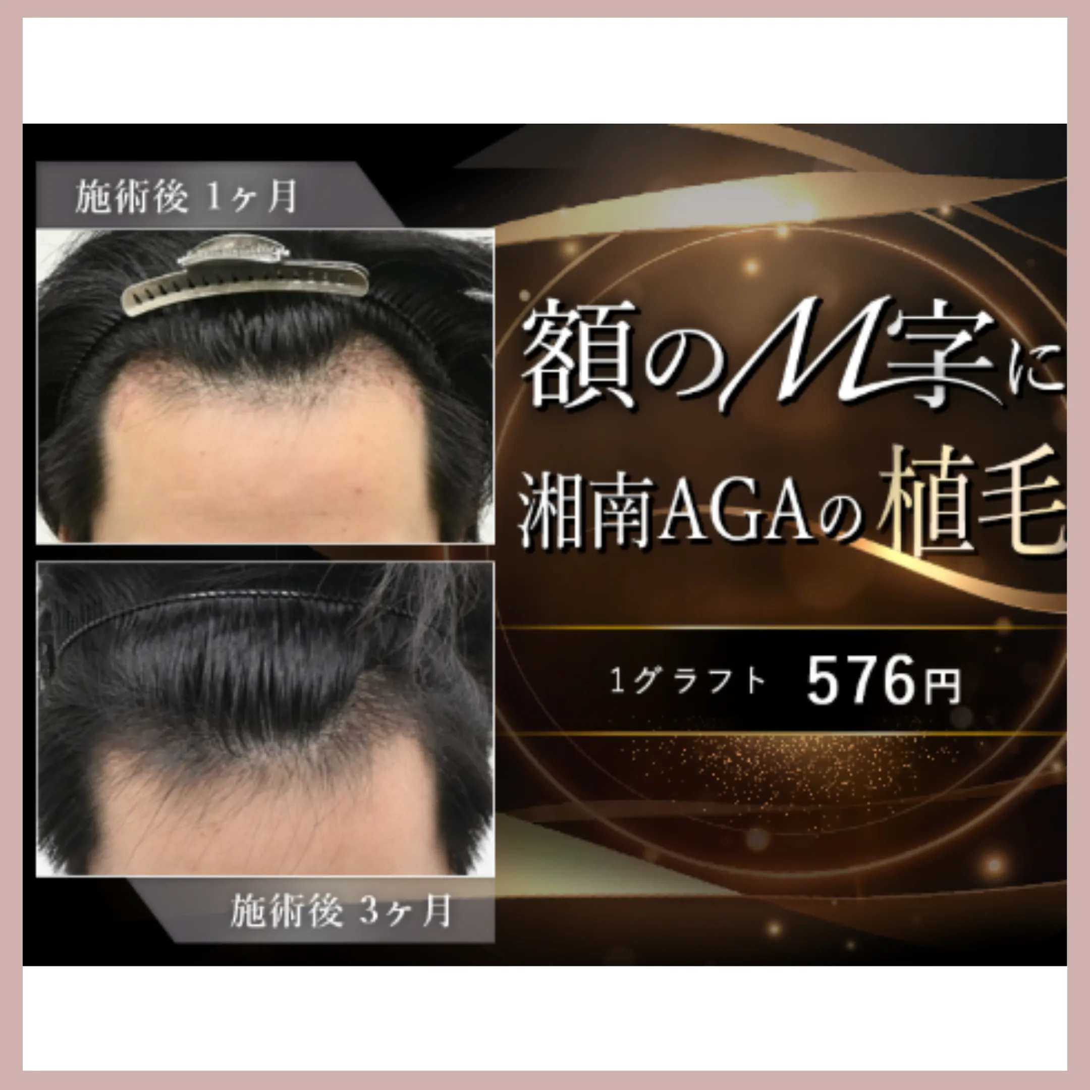 湘南AGAクリニック植毛バナー画像