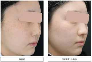 湘南美容クリニックIPL光治療症例写真