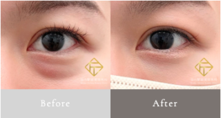 切らないクマ取り