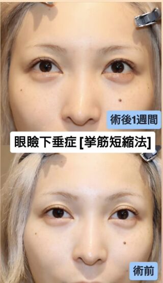 眼瞼下垂（挙筋短縮術）