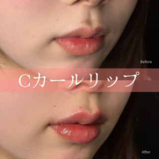 Cカールリップ