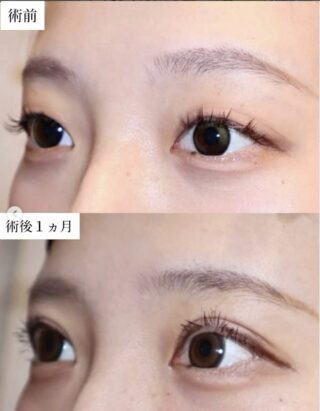 眼瞼下垂：睫毛上皮膚切除