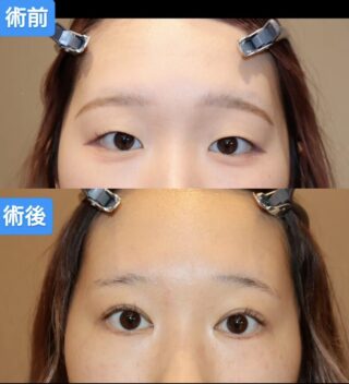 上下の逆さ睫毛