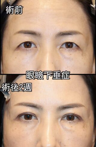 眼瞼下垂