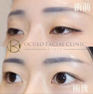 眼瞼下垂：挙筋短縮術