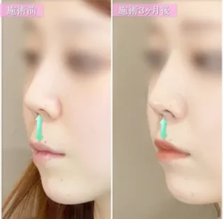 人中短縮術（リップリフト）