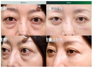 眼窩減圧術（眼球突出の治療・手術）