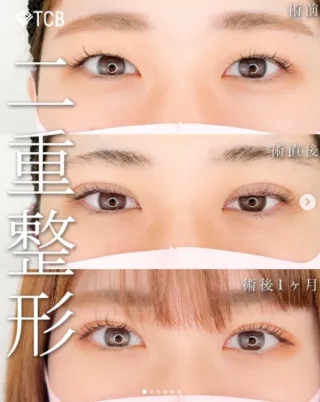 TCB式1dayクイックアイ