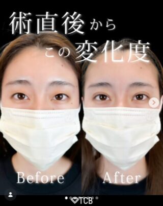 TCB式1dayクイックアイ