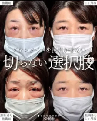 切らない目の下のクマ取り・たるみ取り