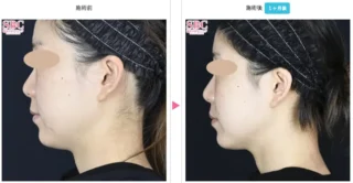 新・脂肪溶解リニアハイフ