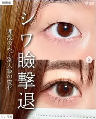 TCB式1dayクイックアイ（二重埋没法）