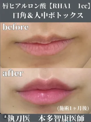 唇ヒアルロン酸　RHA1 1cc＋口角&人中ボトックス