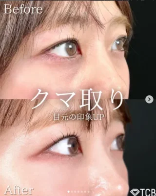 切らない⽬の下のクマ取り・たるみ取り