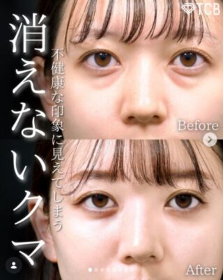 切らない⽬の下のクマ取り・たるみ取り