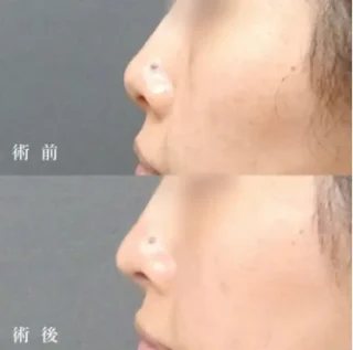 TCB式鼻先尖鋭術