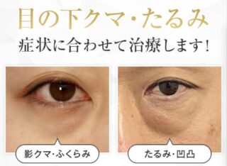 東京美容外科　切らないクマ取り・たるみ取りバナー