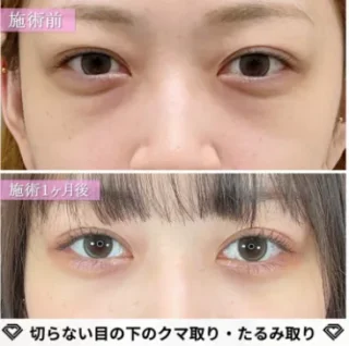 皮膚を切らない目の下のクマ取り・たるみ（ふくらみ）取り