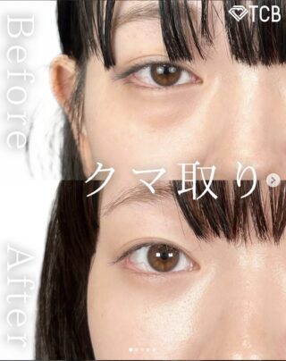 切らない⽬の下のクマ取り・たるみ取り