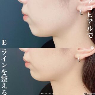 顎ヒアルロン酸（クレヴィエル）