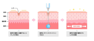アイリスビューティークリニック　ボトックス注射