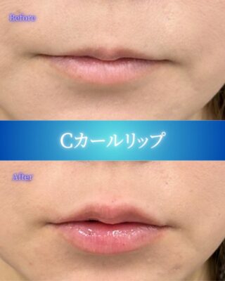 Ｃカールリップ（ボリフト）