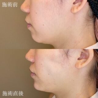 小顔美肌再生（リフトアップ）