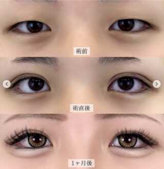 TCB式1dayクイックアイ【二重埋没法】