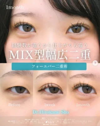 フォーエバー二重術®︎