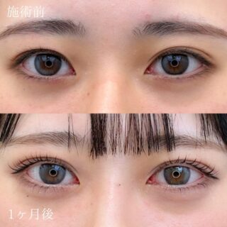 二重埋没法