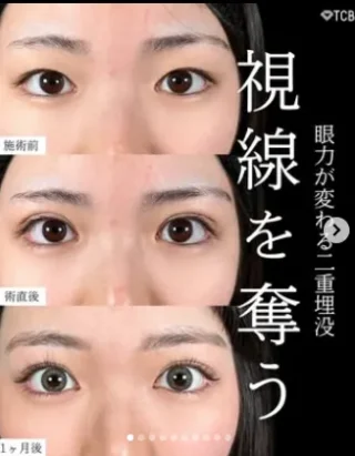 TCB式1dayクイックアイ（二重埋没法）