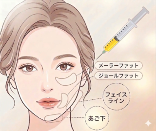 アイリスビューティークリニック　脂肪吸引注射