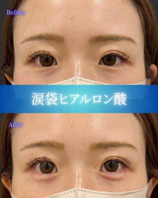 涙袋ヒアルロン酸注入(ボリフト)
