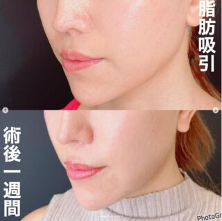 顔脂肪吸引（ホホ下＋フェイスライン＋アゴ下＋エラ下）