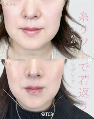 糸リフト【TCB式⼩顔美肌再⽣(ソフト)】