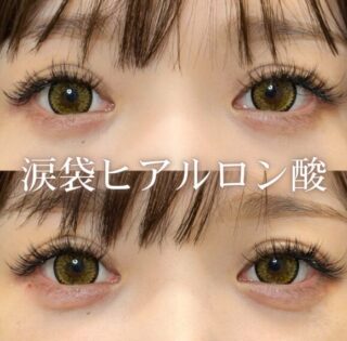 涙袋ヒアルロン酸注入(ボルベラ)