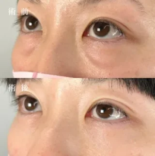 皮膚を切らない目の下のクマ取り・たるみ(ふくらみ)取り