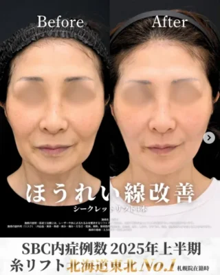 糸リフト・シークレットリフト４本