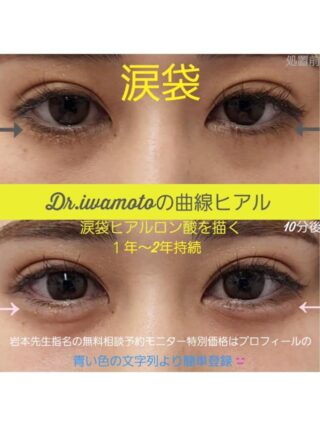 涙袋ヒアルロン酸 (ボルベラ)