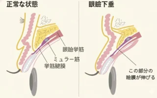 アイリスビューティークリニック眼瞼下垂の症状