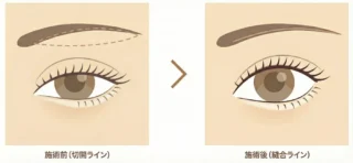 アイリスビューティークリニック眉下切開(眉下リフト)解説図