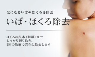 東京美容外科　いぼ・ほくろ除去バナー