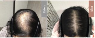 LHDV頭皮注入治療 + es women