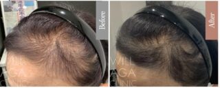 LHDV頭皮注入治療 + es women