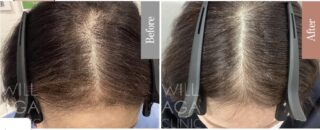 es women + LHDV頭皮注入治療