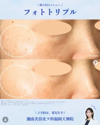 IPL光治療(フォトトリプル)